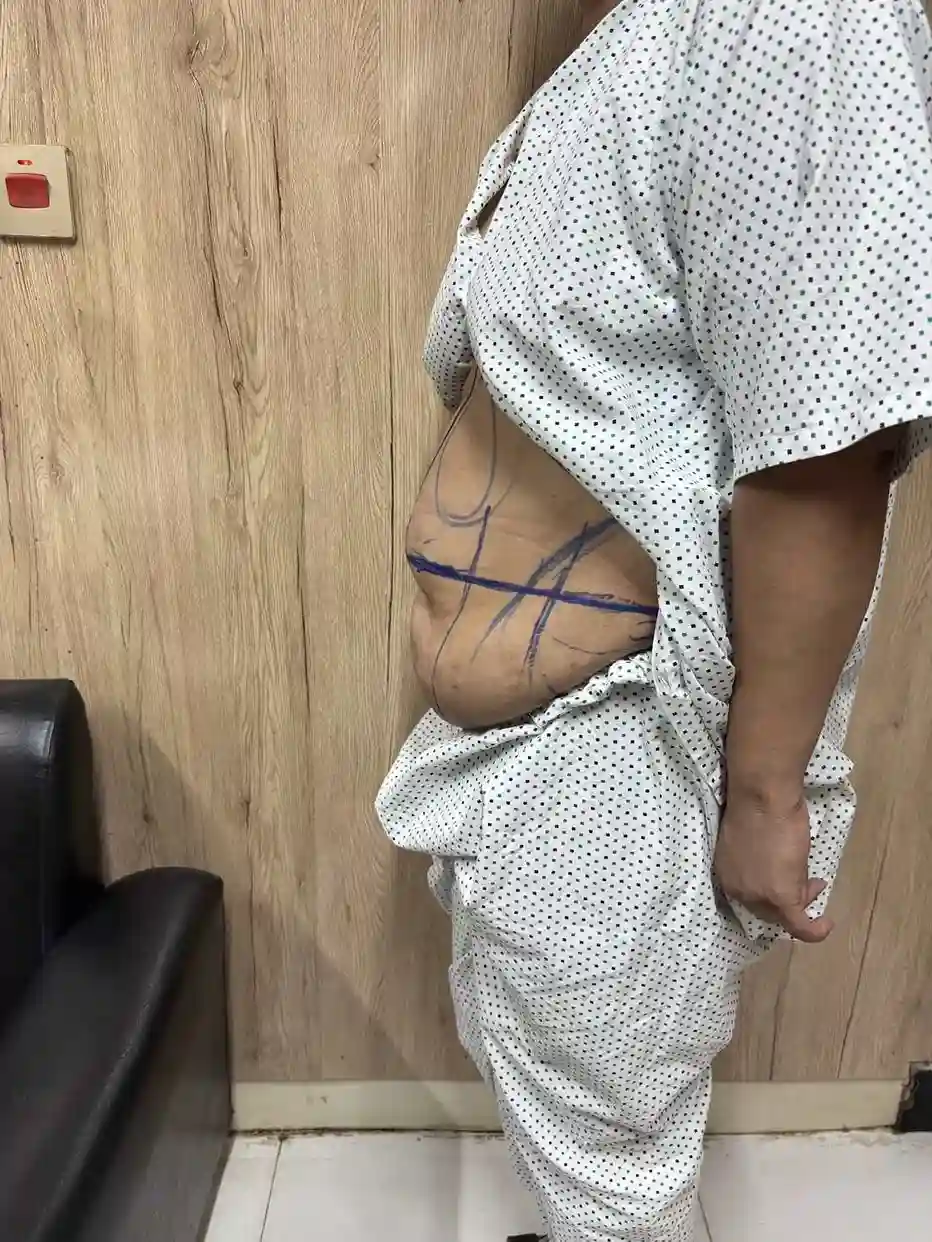 Liposuction