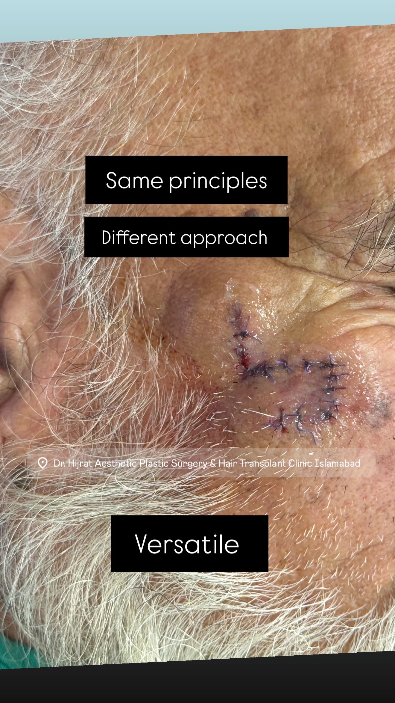 skincancerbefore - After