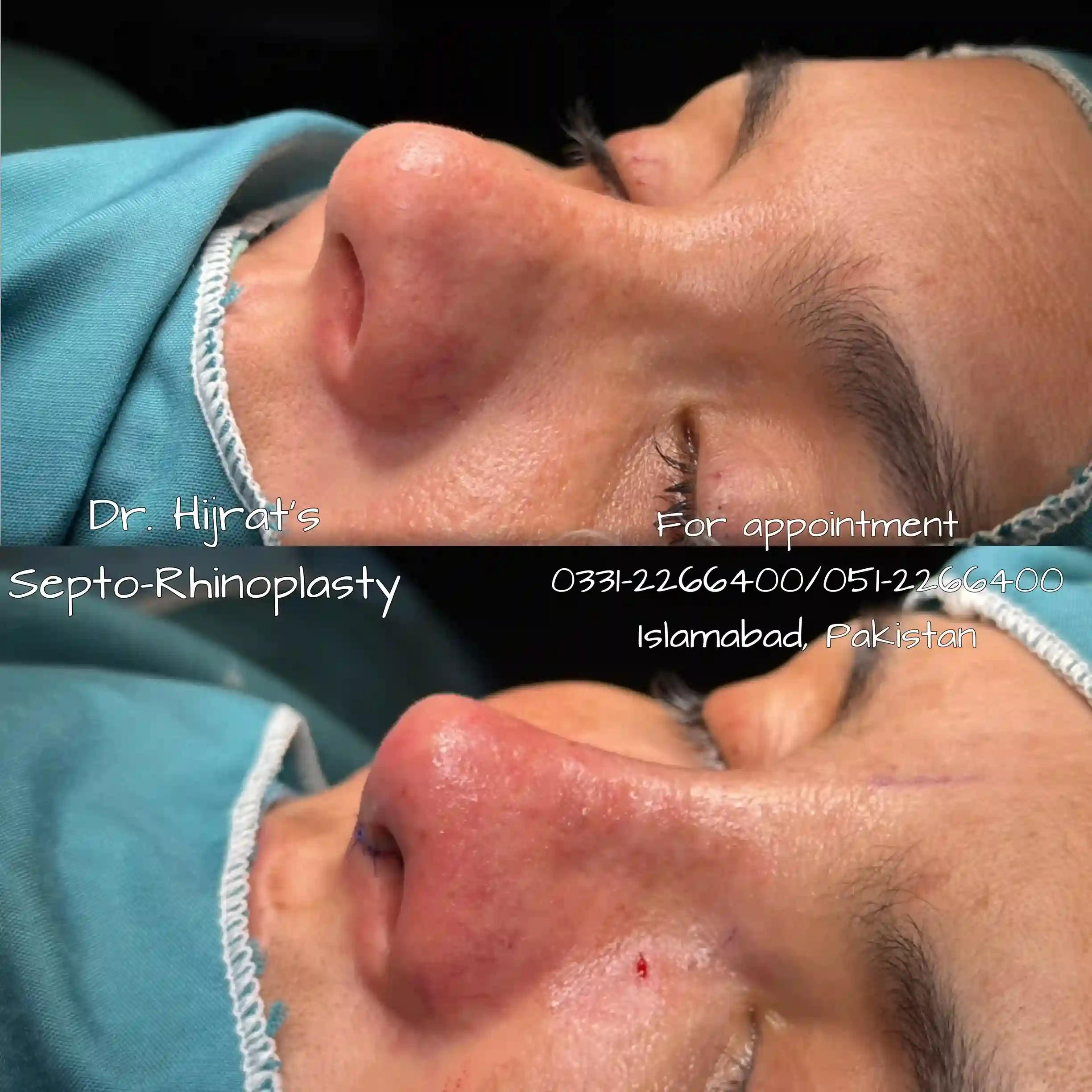 Rhinoplasty