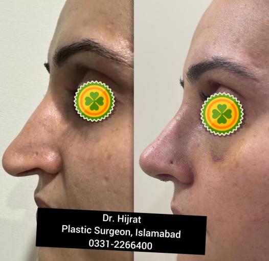 Rhinoplasty Image 1
