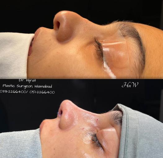 Rhinoplasty Image 2