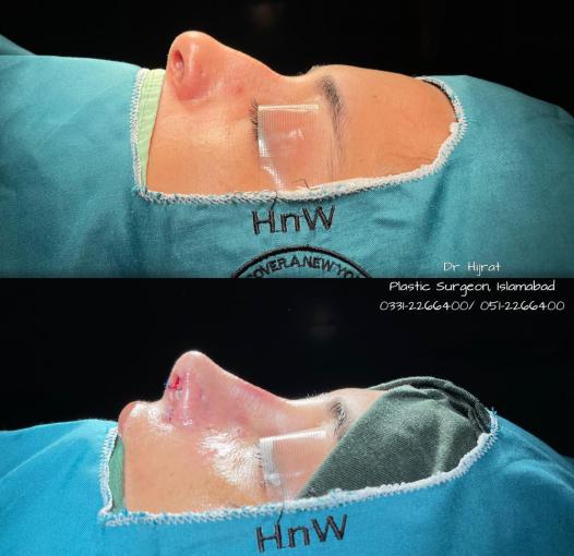 Rhinoplasty Image 3