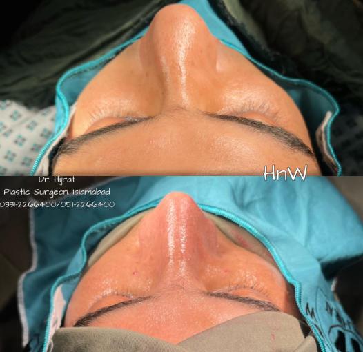 Rhinoplasty Image 4