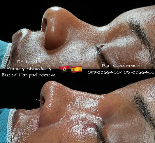 Rhinoplasty Image 5
