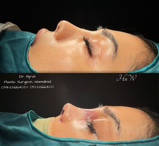 Rhinoplasty Image 6