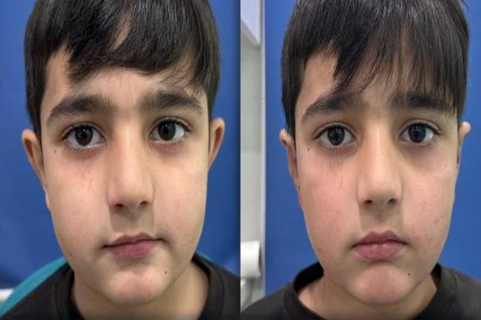 Otoplasty