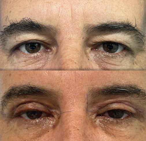 Upper Eyelid Surgery