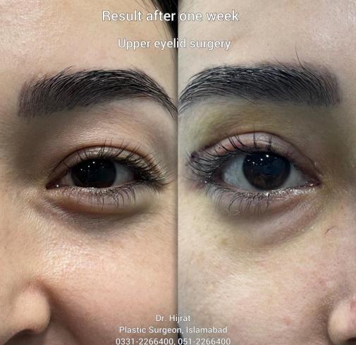 Lower Eyelid Surgery
