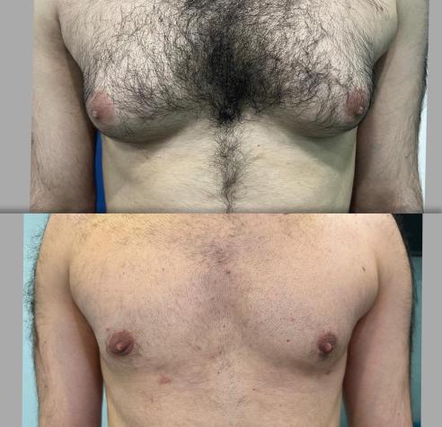 Gynecomastia Surgery 1