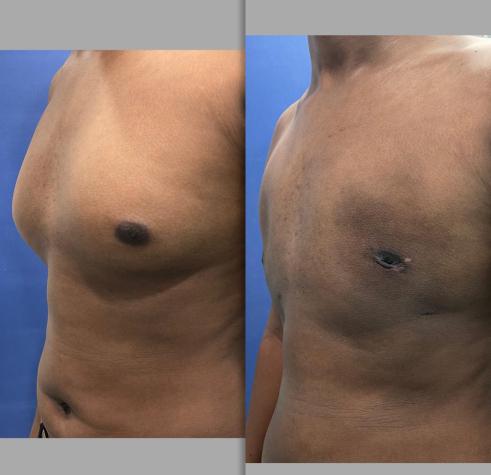 Gynecomastia Surgery 2