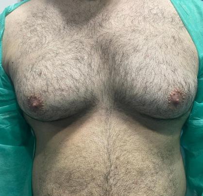 Gynecomastia Surgery 3