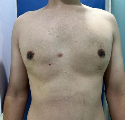 Gynecomastia Surgery 4