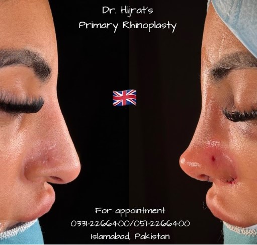 rhinoplasty images