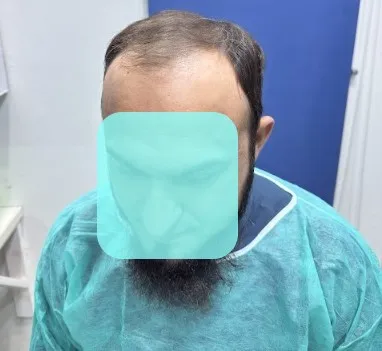 Hair transplant clinic Islamabad