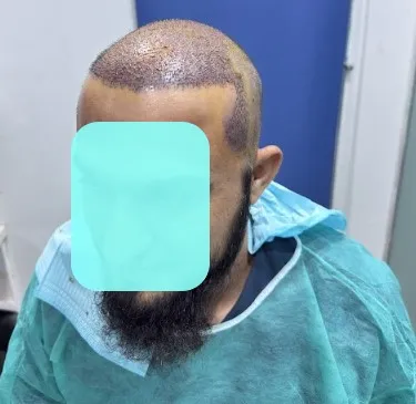 Hair Transplant