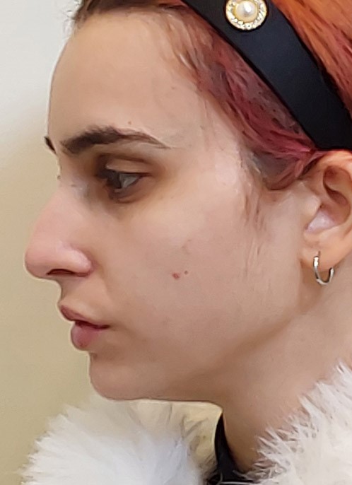 Before Thread Lift