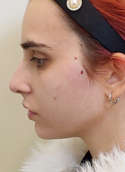 After Thread Lift