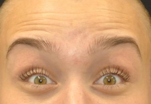Botox